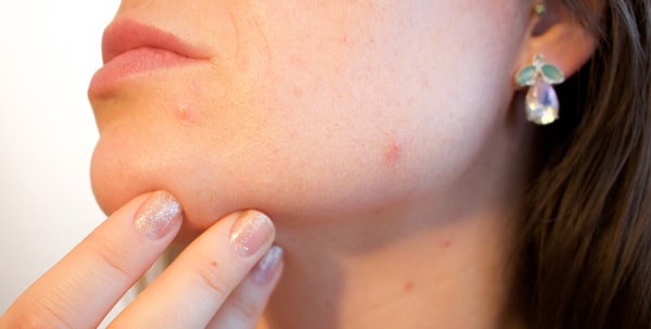 Stronger treatments for acne